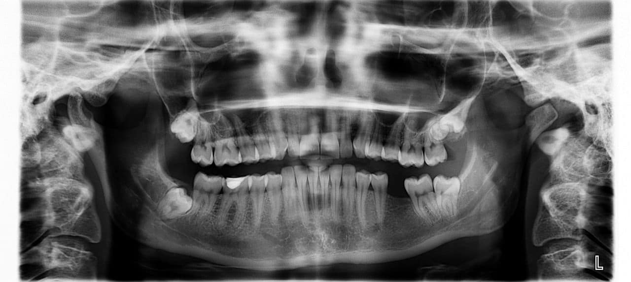 Radiografía implante dental