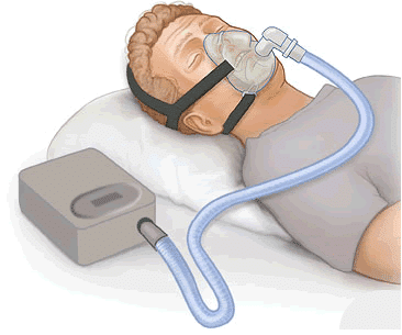CPAP apnea 